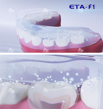 ETA牙齿矫正器.jpg