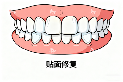 牙齿贴面修复卡通图.png 牙齿贴面修复卡通图.png