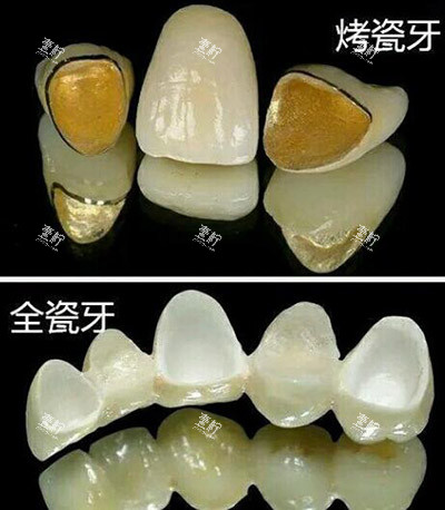 烤瓷牙冠全瓷冠对比.jpg