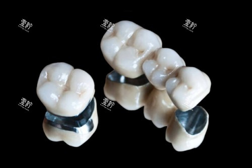 烤瓷牙冠模型图.jpg