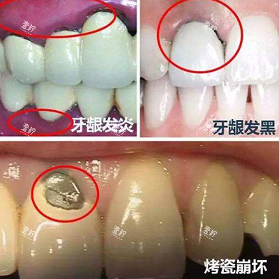 烤瓷牙冠修复缺点.jpg