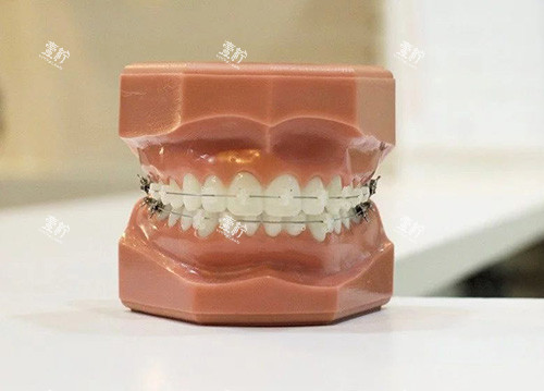 牙齿矫正陶瓷托槽牙套模型.jpg