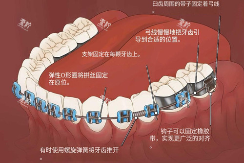 金属牙齿矫正器功能示意图.jpg