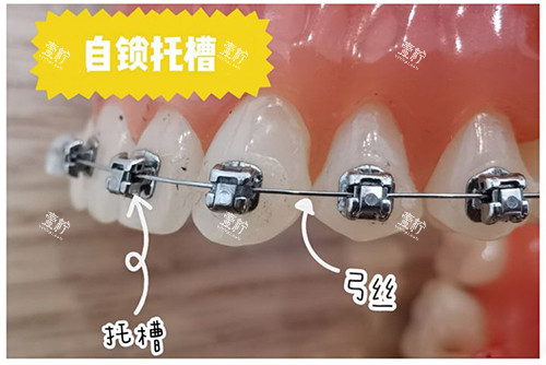 牙齿矫正自锁托槽牙套.jpg