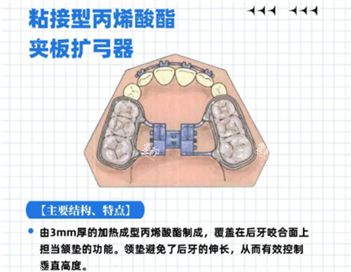 粘接式扩弓器结构特点.jpg