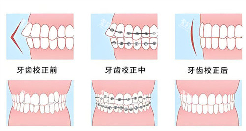牙齿矫正前后对比图.jpg