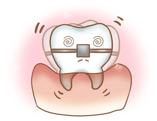 牙齿矫正松动.webp.png 牙齿矫正松动.webp.png