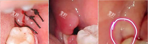 拔智齿缝合示意图.jpg