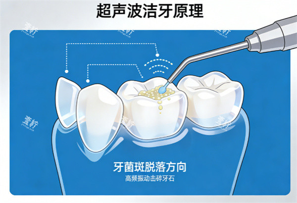 超声波洁牙原理示意图.jpg 超声波洁牙原理示意图.jpg