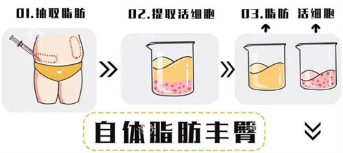 自体脂肪移植过程.jpg 自体脂肪移植过程.jpg