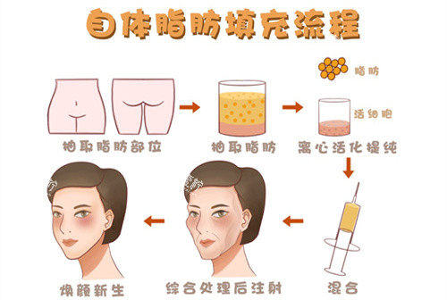 自体脂肪移植填充额头动画演示图.jpg 自体脂肪移植填充额头动画演示图.jpg