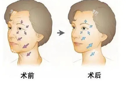 面部抗衰前后对比卡通示意图.jpg 面部抗衰前后对比卡通示意图.jpg