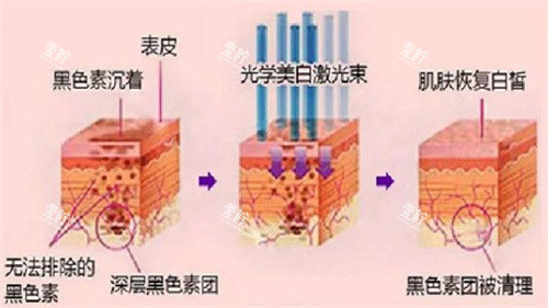 光子嫩肤原理.jpg 光子嫩肤原理.jpg