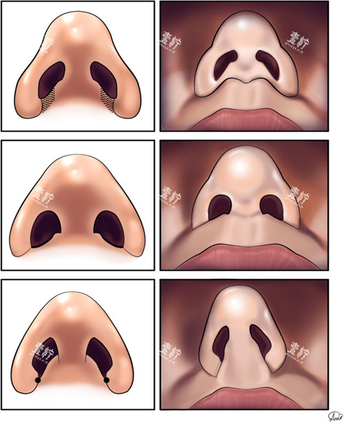 鼻整形的对比.jpg 鼻整形的对比.jpg