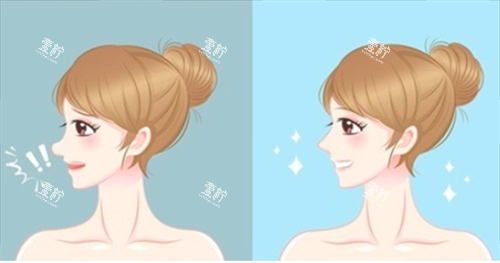 鼻修复对比.png 鼻修复对比.png