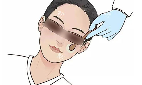 光子嫩肤示意图.jpg 光子嫩肤示意图.jpg