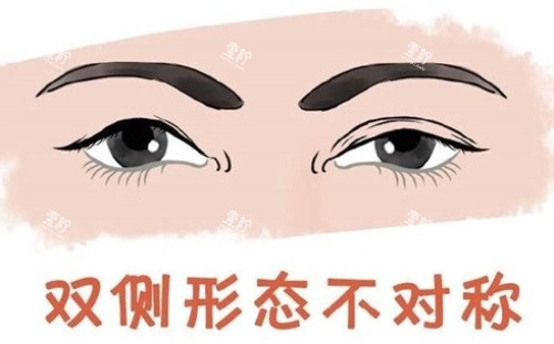 双眼皮形态不对称.JPG