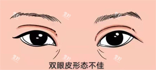 双眼皮修复示图.jpg 双眼皮修复示图.jpg