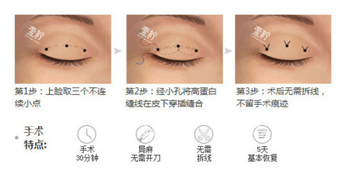 双眼皮三点术过程特点.jpg 双眼皮三点术过程特点.jpg
