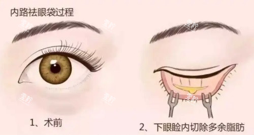 祛眼袋示意图.JPG 祛眼袋示意图.JPG