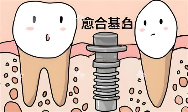 种植牙卡通动画图片展示.jpg