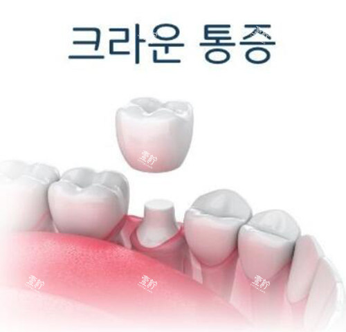 磨牙后牙冠修复改善.jpg