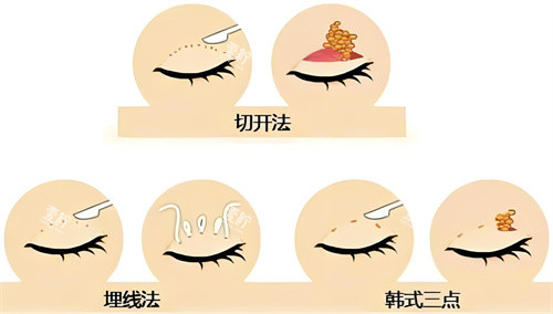 双眼皮方法对比图.jpg