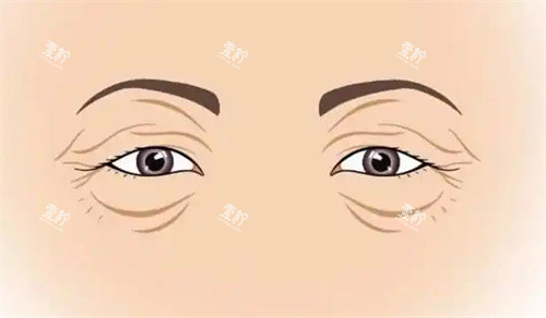 衰老的双眼皮.jpg