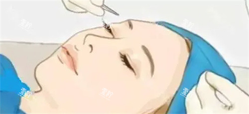 双眼皮手术过程卡通图.jpg