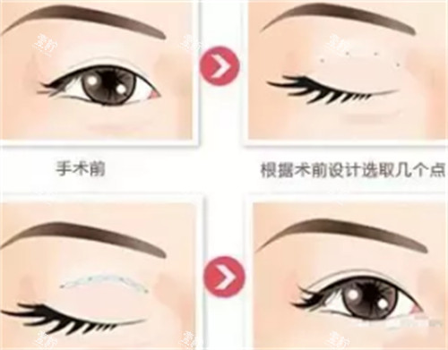 贝塞尔双眼皮手术过程图解.jpg