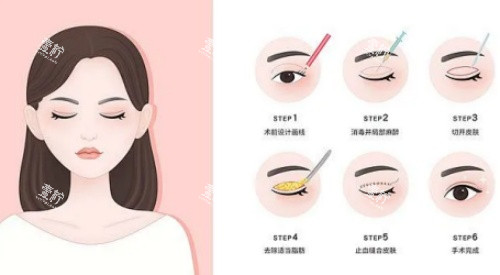 拉双眼皮手术示意图.jpg