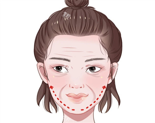面部抗衰提升卡通图.jpg