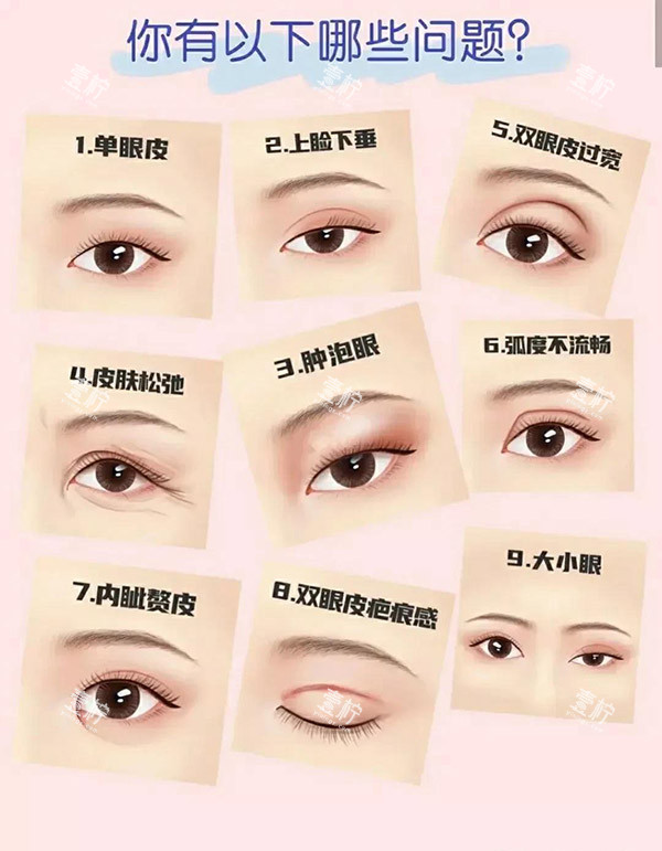 双眼皮类型图片.jpg