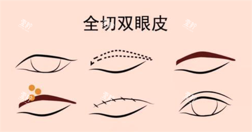 全切双眼皮经过.png