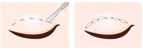 双眼皮切开vs双眼皮埋线.jpg