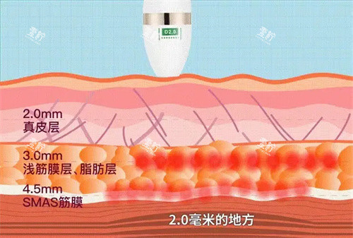 超声炮层次.jpg