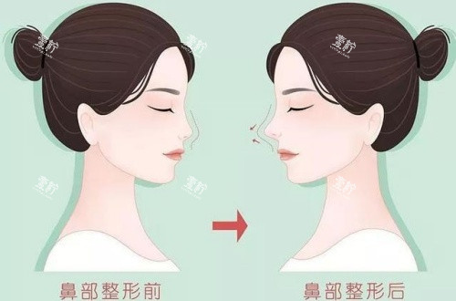 隆鼻术后漫画示意图.jpg 隆鼻术后漫画示意图.jpg
