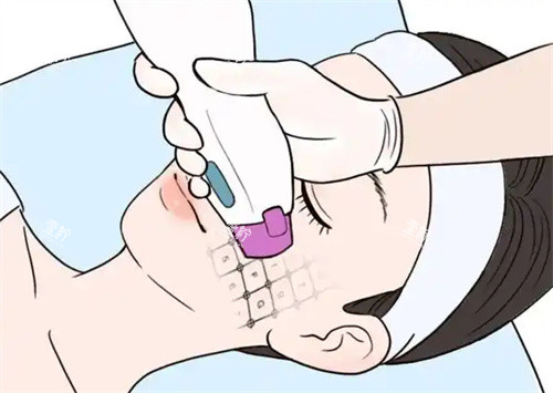 面部热玛吉卡通图片.jpg 面部热玛吉卡通图片.jpg