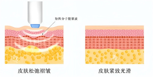 热玛吉作用对比.jpg 热玛吉作用对比.jpg