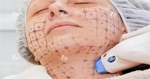 热玛吉中下面部设计点位图.jpg 热玛吉中下面部设计点位图.jpg