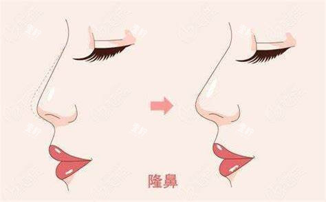 隆鼻术图.jpg