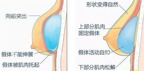 内窥镜隆胸.jpg