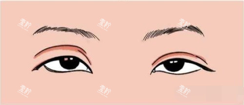 双眼皮过宽.JPG