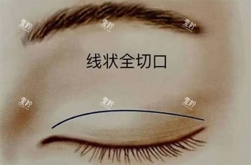 双眼皮失败怎么办.jpg