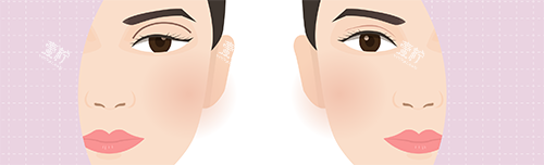 双眼皮失败修复.png
