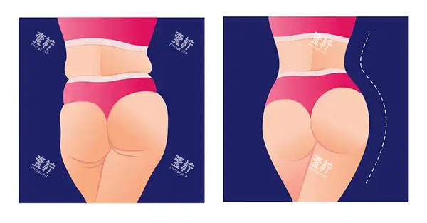 臀部脂肪填充.jpg 臀部脂肪填充.jpg
