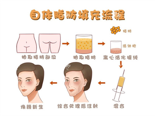 面部自体脂肪填充流程演示动画图.jpg 面部自体脂肪填充流程演示动画图.jpg