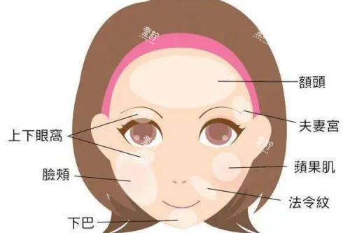 面部可以脂肪填充的部位卡通图.jpg 面部可以脂肪填充的部位卡通图.jpg