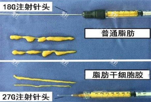 自体脂肪填充需要的脂肪提纯后的样子图片.jpg 自体脂肪填充需要的脂肪提纯后的样子图片.jpg