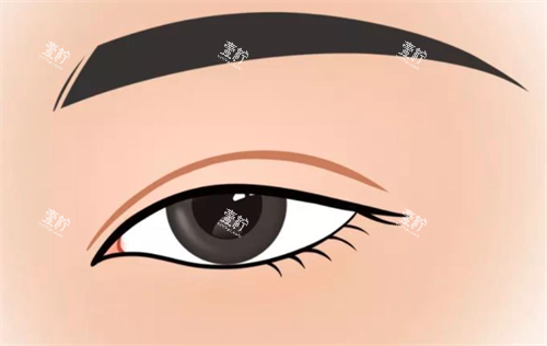 双眼皮手术.png 双眼皮手术.png